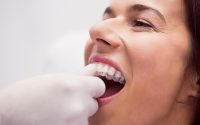 4 riscos de fazer um clareamento dental caseiro